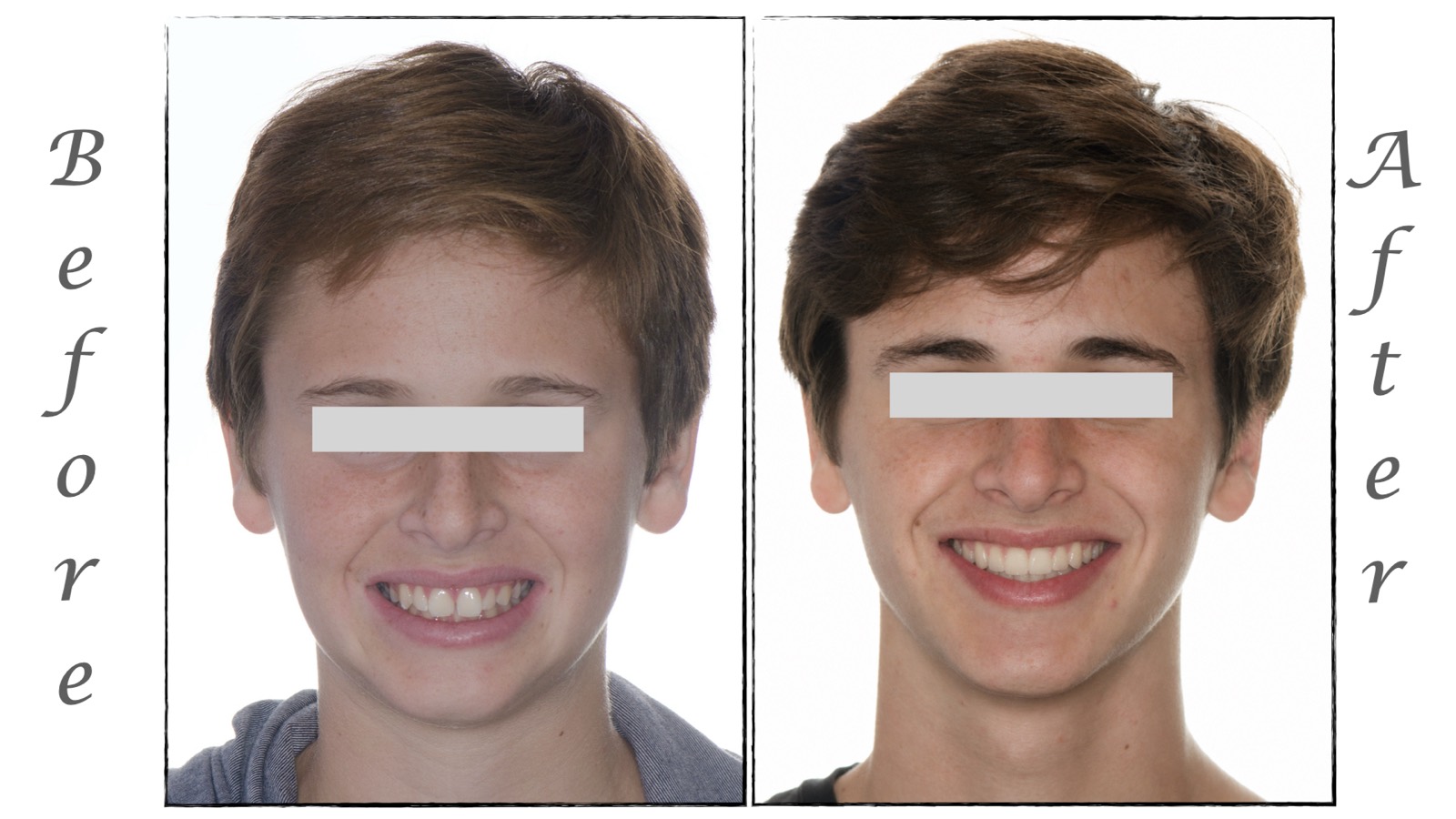 Orthodontic case by Dr. Chirag